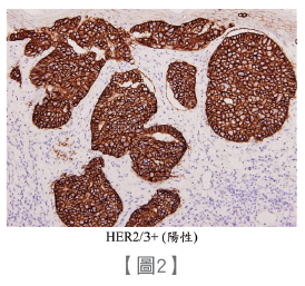 精準打擊癌細胞 乳癌雙標靶治療
